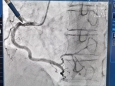 精准介入时代来临，我院使用FFR指导冠脉介入决策