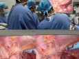我院完成首例胸腔镜辅助下袖状肺叶切除术+肺动脉成形术