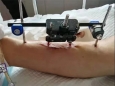关节外科安装一个“发动机”，使患者免受截肢之苦